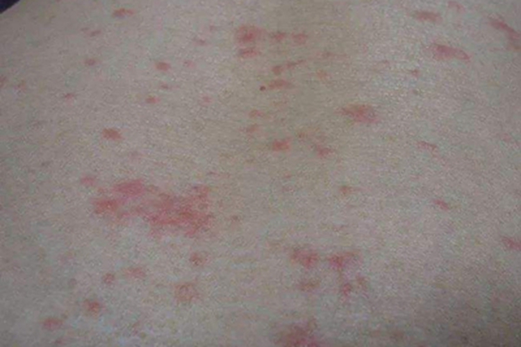 流行性斑疹伤寒背部丘疹图