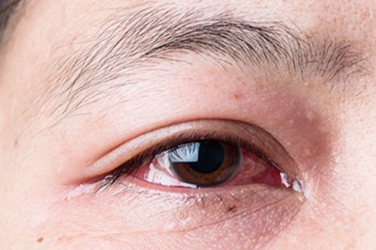 银屑病关节炎眼部红肿图