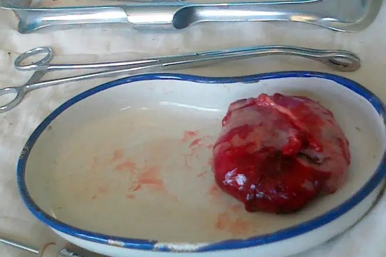 未成熟畸胎瘤图