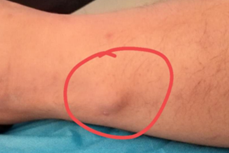 平滑肌瘤小腿症状图 平滑肌瘤小腿症状图