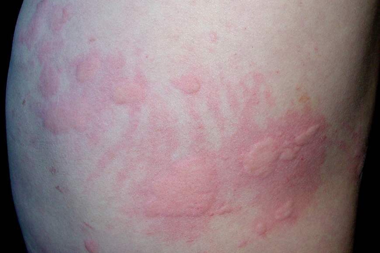 急性自发性荨麻疹图 急性自发性荨麻疹图