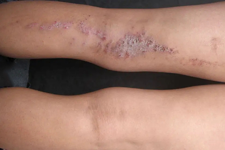 线状苔藓早期图