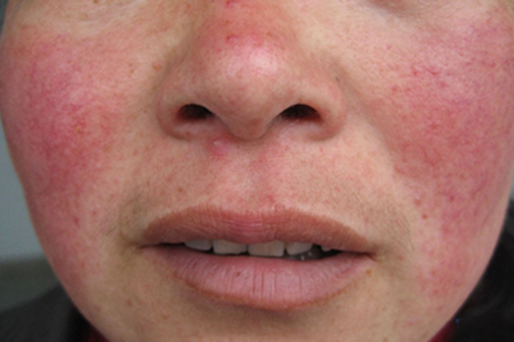 皮肤过敏红肿脸上红斑图 皮肤过敏红肿脸上红斑图