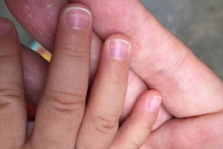 宝宝线状白甲图