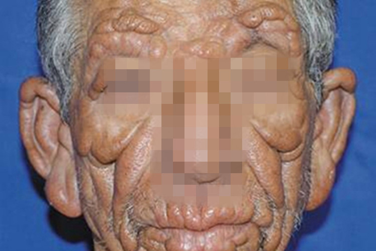 瘤型麻风面部变形图