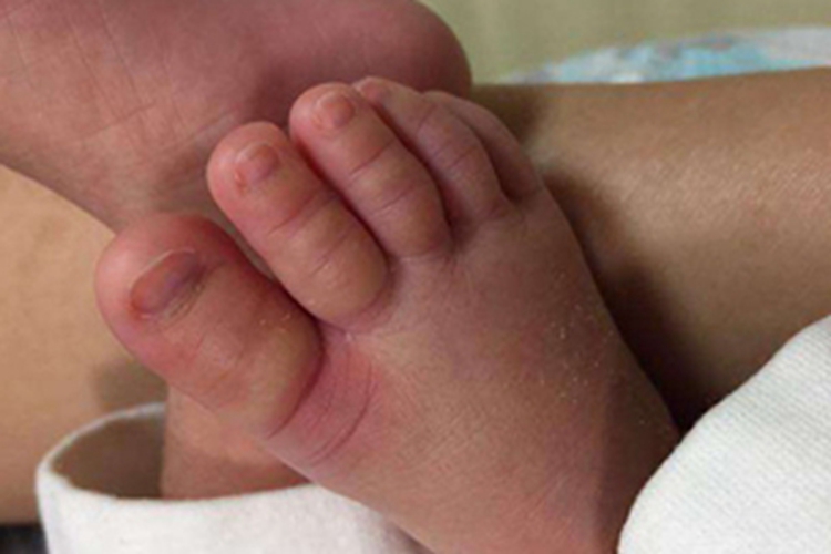 新生儿水肿脚趾肿胀图