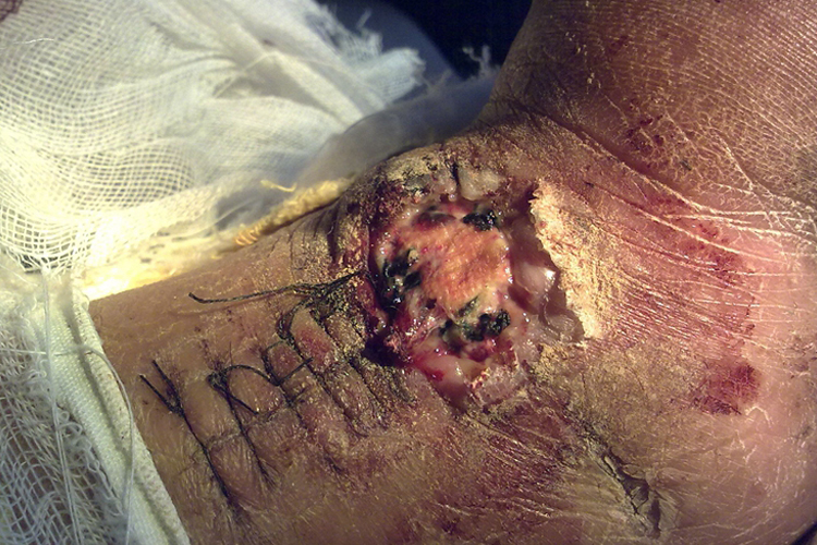 跟腱手术伤口坏死不愈合图