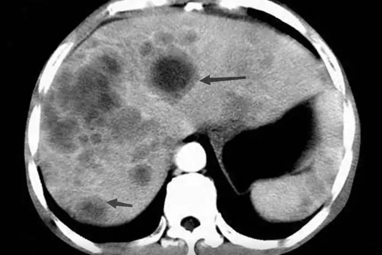 转移性肝癌牛眼征图