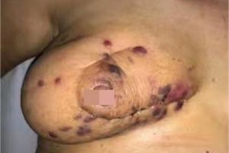 放射后血管肉瘤乳房症状图