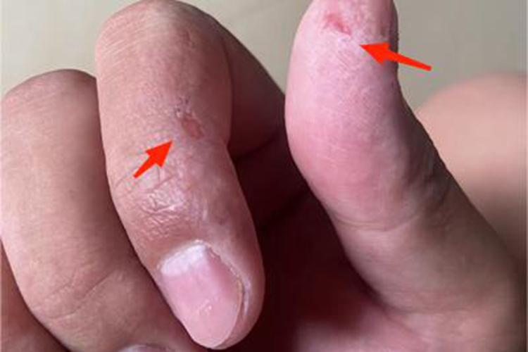 汗疱疹手指皮肤有红色糜烂图