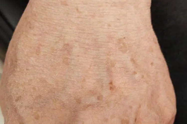 光老化手背有棕褐色斑图