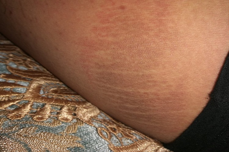 黑棘皮病大腿症状图 黑棘皮病大腿症状图