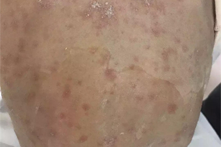 轻型多形红斑型药疹背部症状图