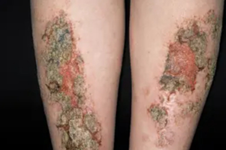 感染性湿疹小腿结痂图