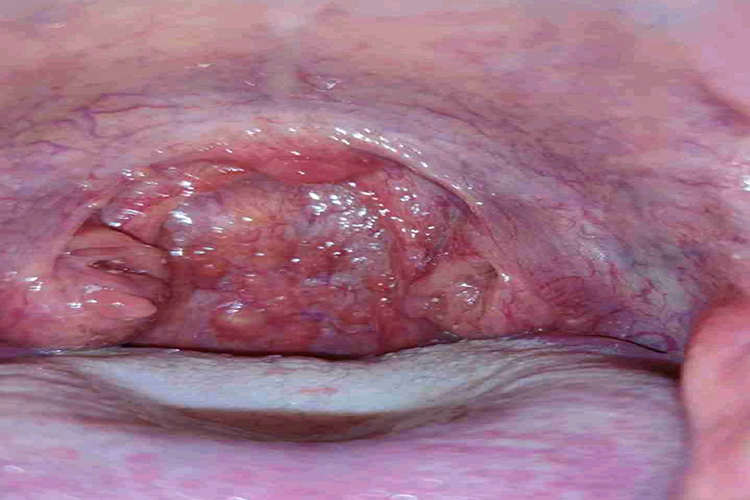 慢性咽炎图 慢性咽炎图