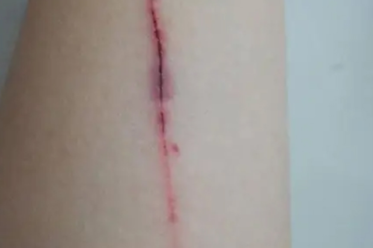 胳膊划伤闭合性损伤图