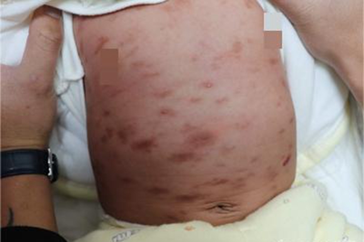 皮肤肥大细胞增生病斑图