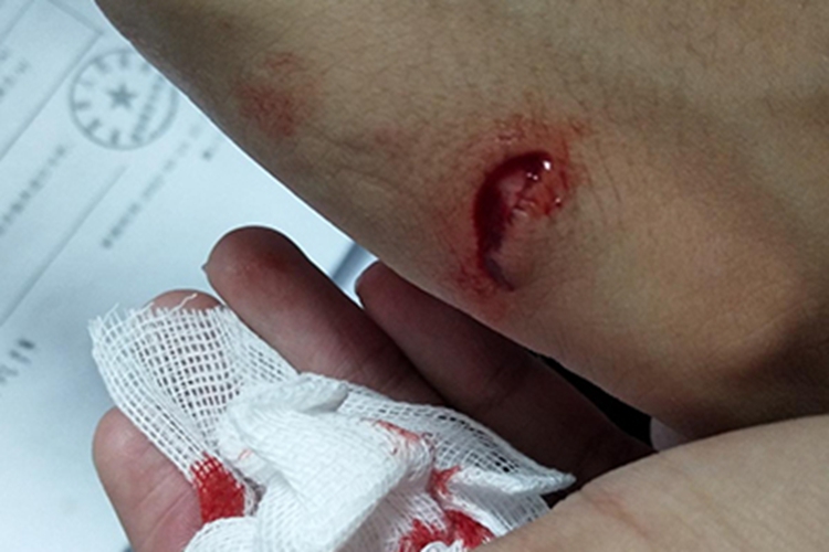 划伤手部红肿图