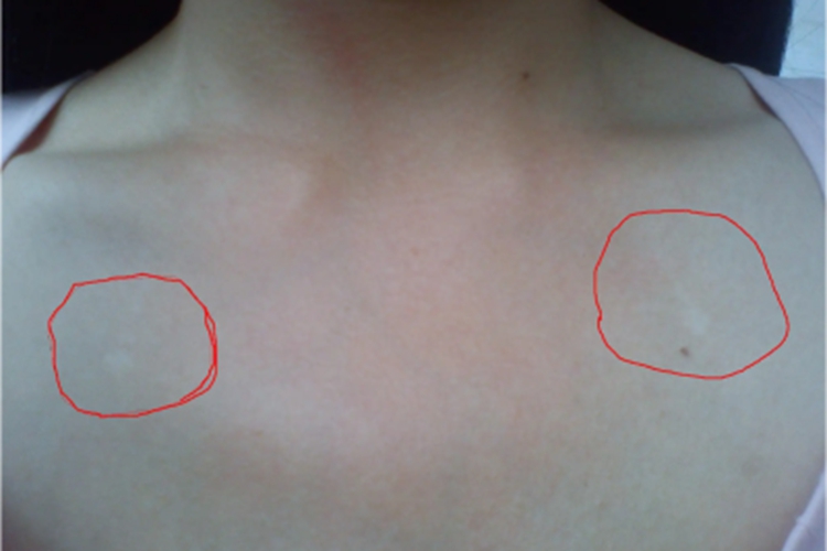 贫血痣胸部症状图