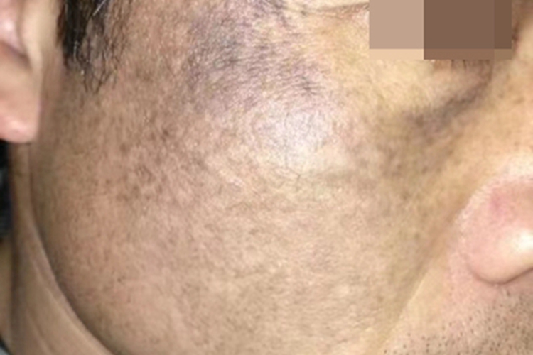 太田痣面部有紫色斑片图