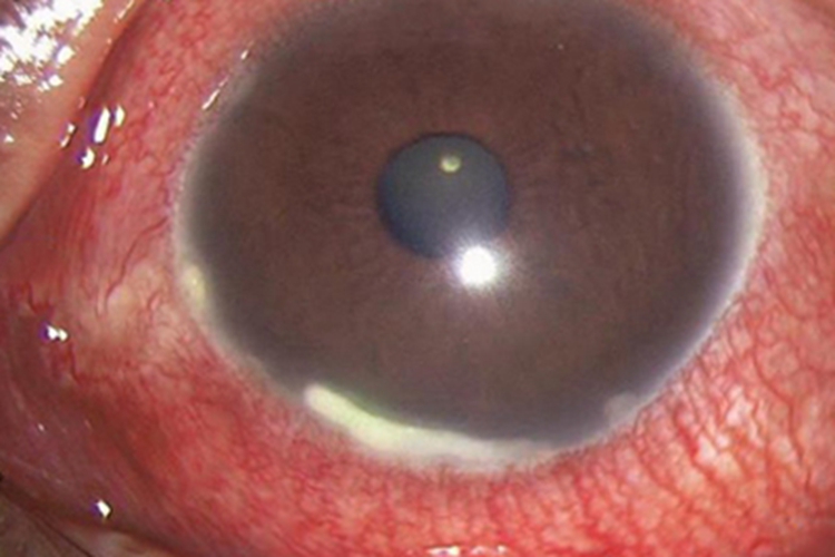 细菌性角膜炎白斑图