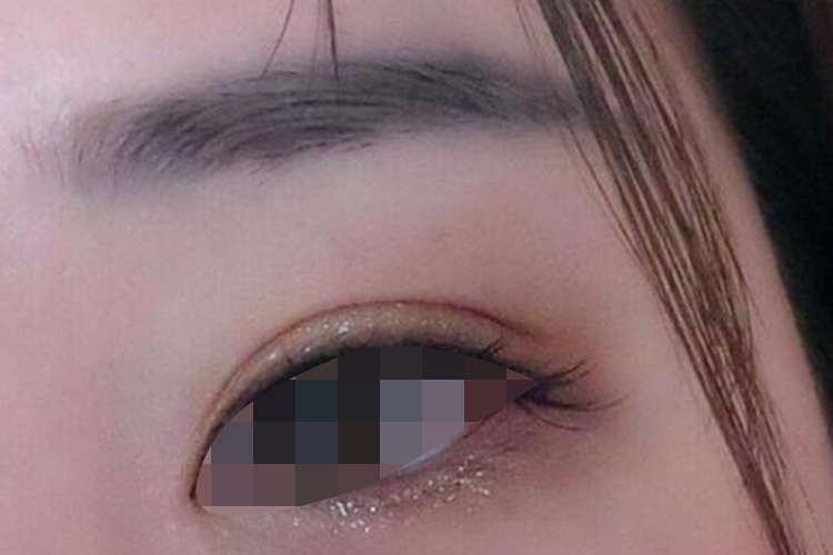 内低外高型双眼皮图