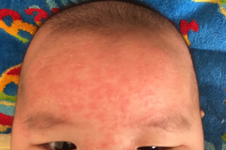 小孩额头湿疹图 小孩额头湿疹图