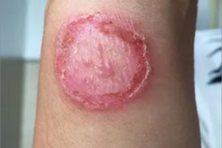 皮肤利什曼病症状图