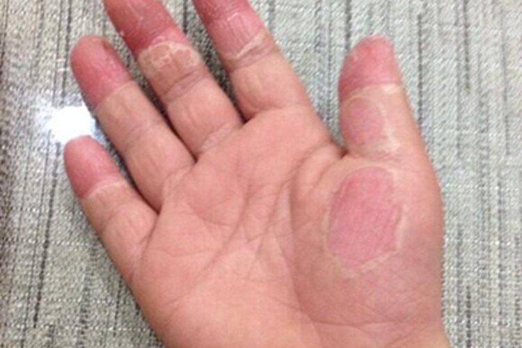 特应性皮炎手掌症状图