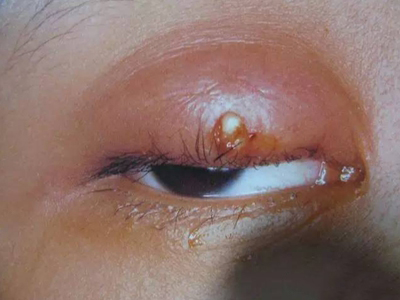 上眼皮睑腺炎图片图片