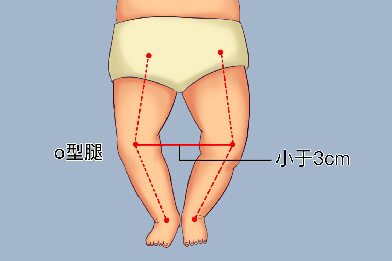 宝宝轻度O型腿图
