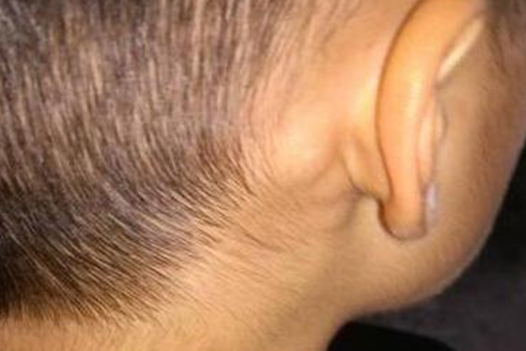 小孩耳后淋巴结肿大图