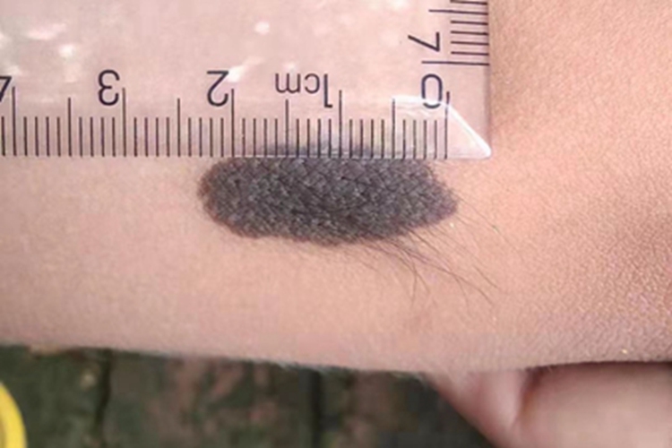 色素性毛表皮痣胳膊症状图