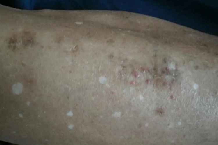 老年性点状白斑腿白点图