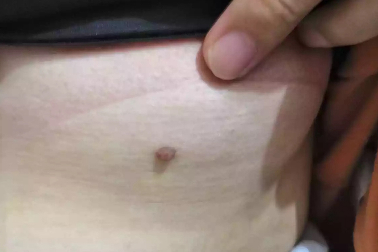 乳房周围的寻常疣图