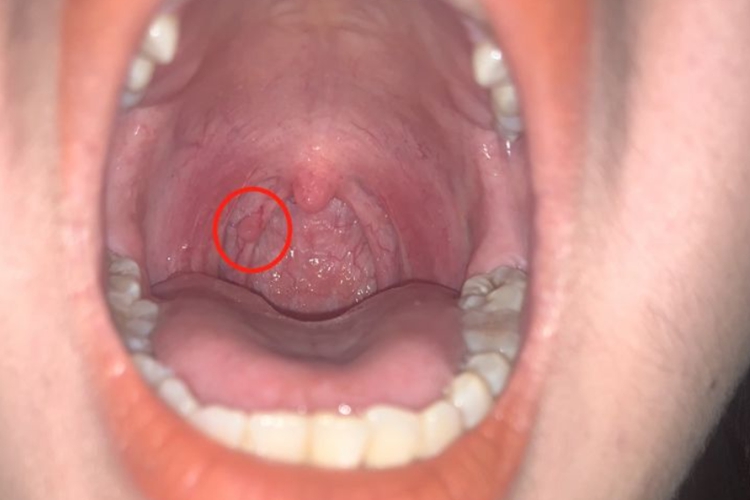 右侧喉乳头状瘤图 右侧喉乳头状瘤图