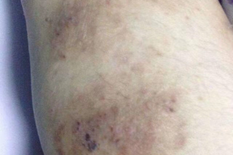 亚急性湿疹小腿血痂图