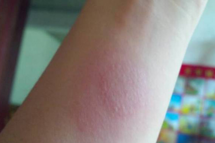 48-72小时皮肤水疱图