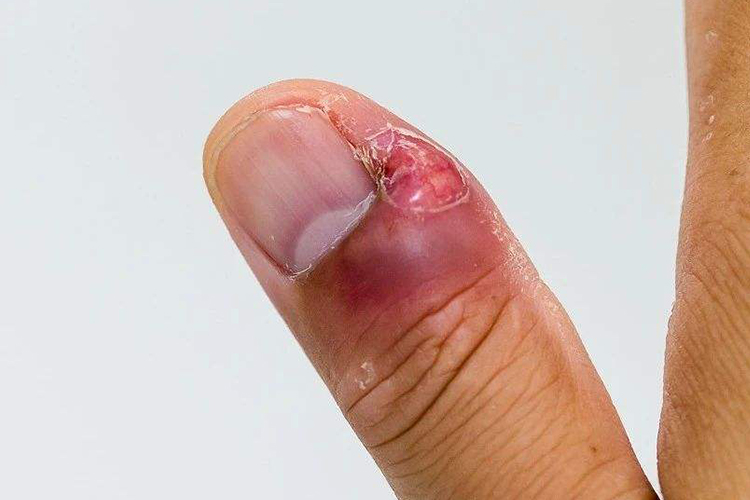 甲沟炎图