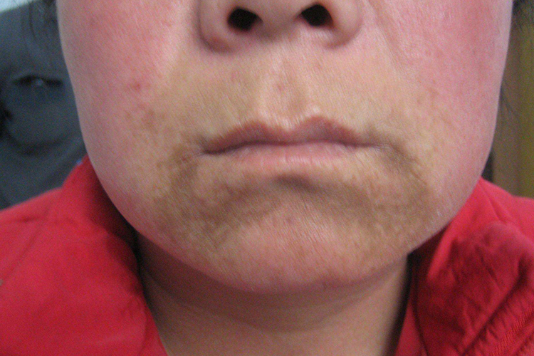 下巴长黄褐斑图