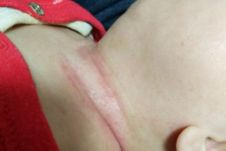 红痱脖子出现两条红线图