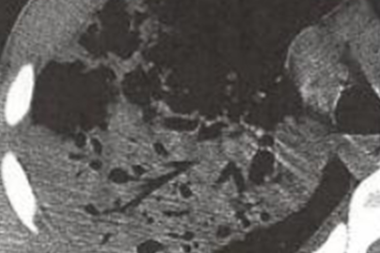 继发型肺结核干酪样CT表现图