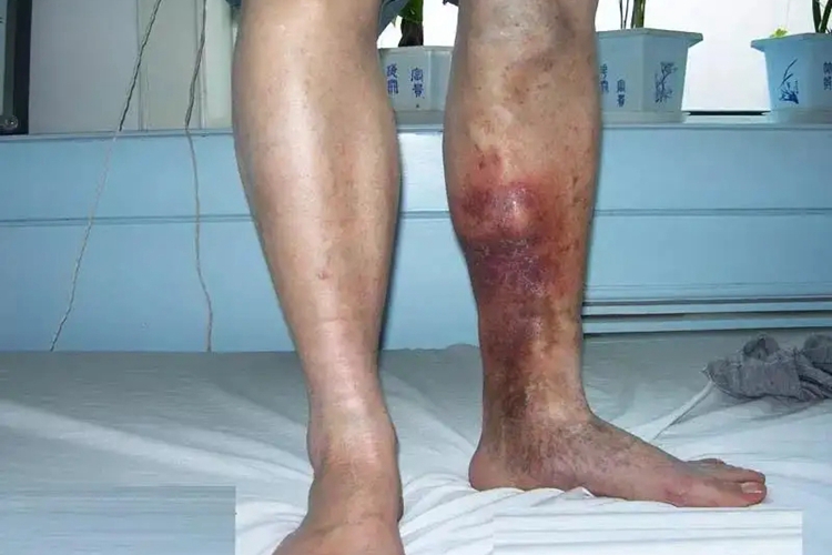 浅静脉血栓图 浅静脉血栓图