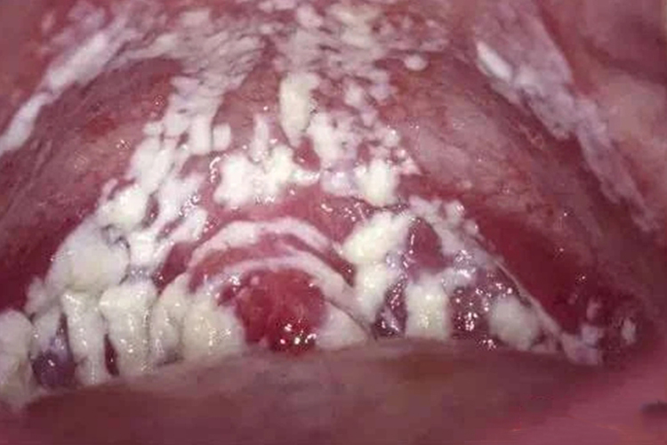 外阴阴道假丝酵母菌病图