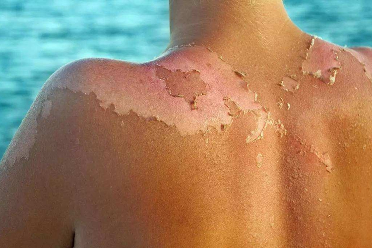 晒伤后的皮肤图