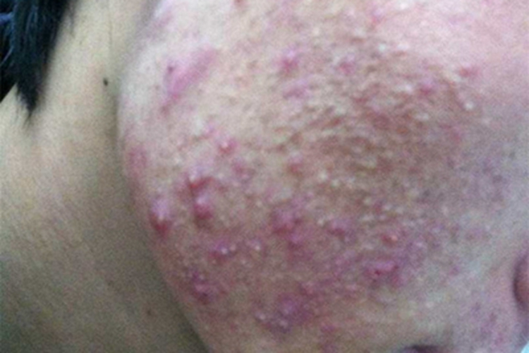 聚合性痤疮面部有密集疙瘩图 聚合性痤疮面部有密集疙瘩图