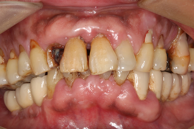 牙龈增生的症状和图片