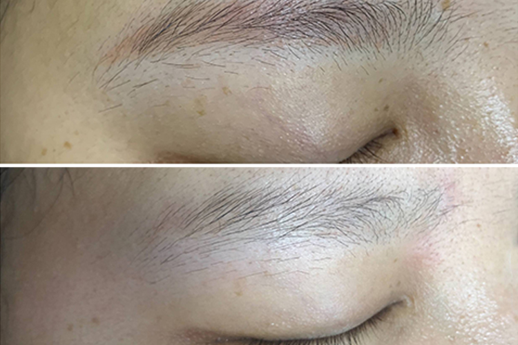 激光洗眉对比图