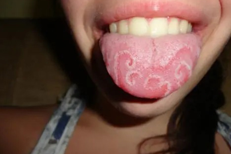 舌尖部地图舌图