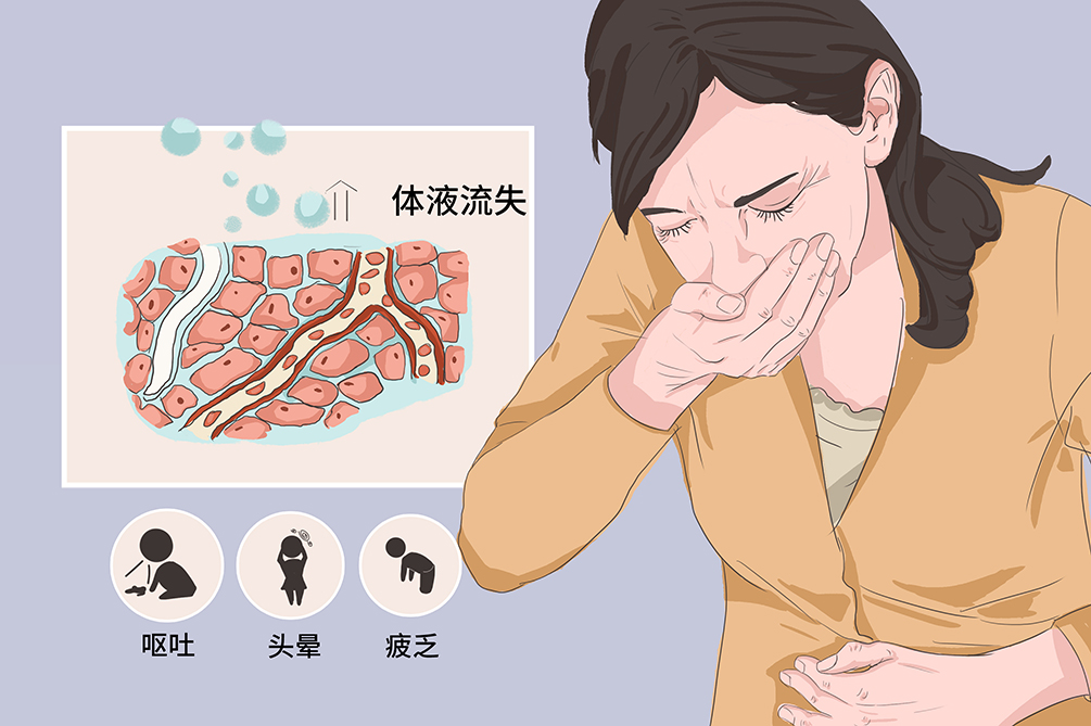 低渗性脱水是指机体内水和钠同时缺失,但失钠多于失水,故血清钠低于